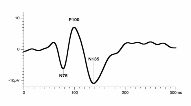 Normal Eye Test Normal Vep Results