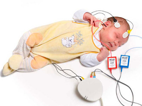 Figure 3 from Brainstem Electric Response Audiometry (BERA)in the  Evaluation of Hearing Loss in Infants with Cleft Palate